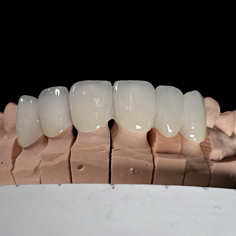 Dental Transparent Multilayer Colored Zirconia Crown